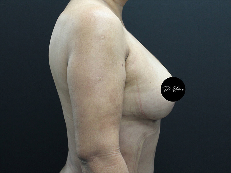 Case--6197 | After Breast Implant Removal w/ Lift & Fat Grafting 3