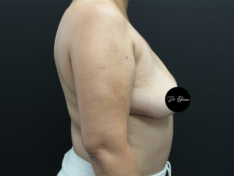 Case--6197 | Before Breast Implant Removal w/ Lift & Fat Grafting 3