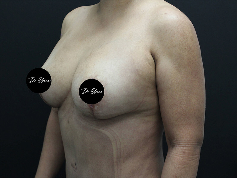 Case--6197 | After Breast Implant Removal w/ Lift & Fat Grafting 4