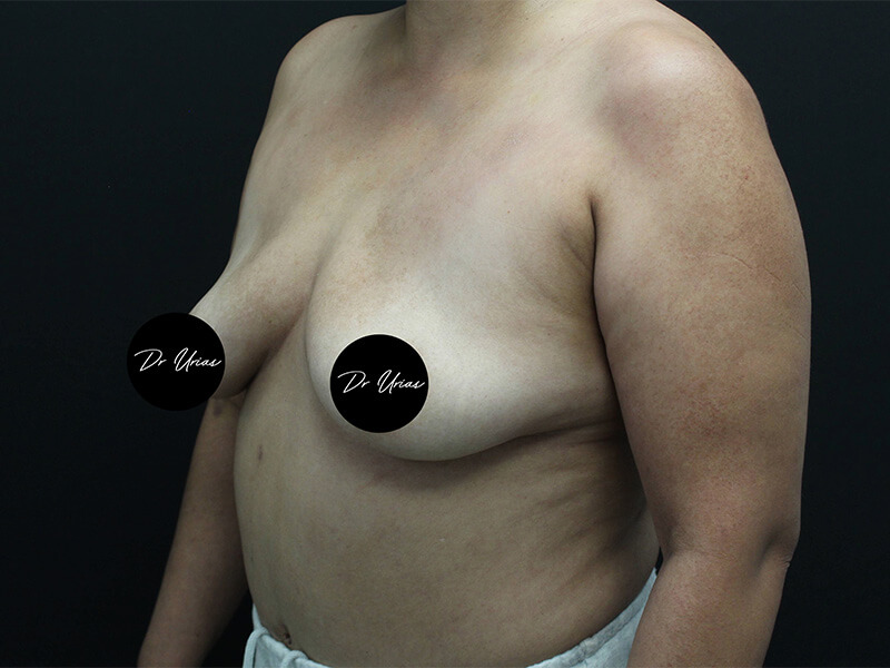 Case--6197 | Before Breast Implant Removal w/ Lift & Fat Grafting 4