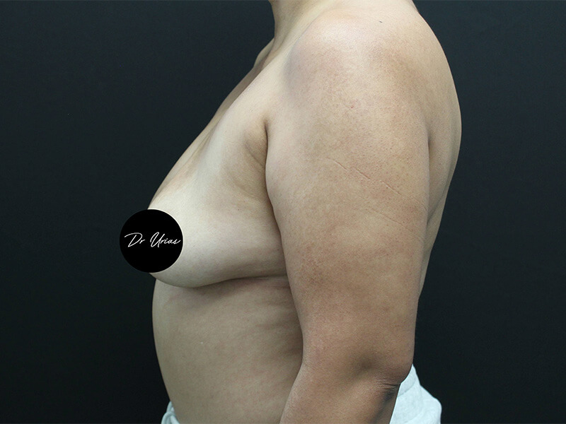 Case--6197 | Before Breast Implant Removal w/ Lift & Fat Grafting 5