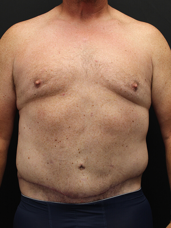 Case--6379 | After Abdominoplasty 1
