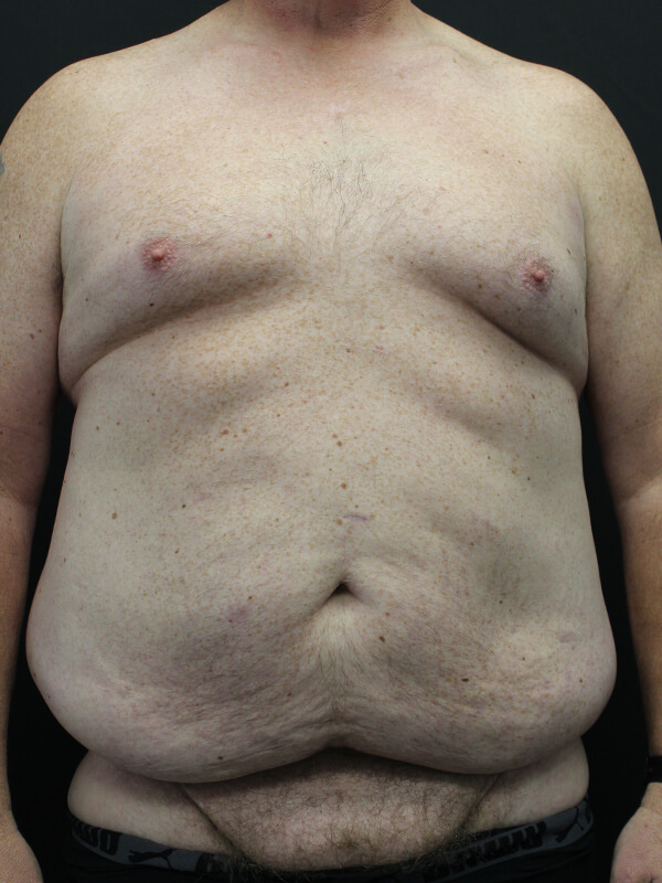 Case--6379 | Before Abdominoplasty 1