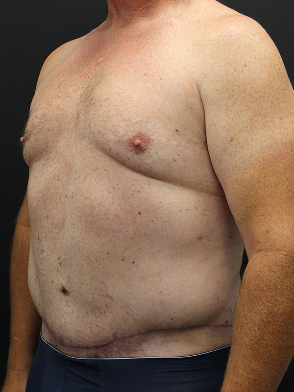 Case--6379 | After Abdominoplasty 2