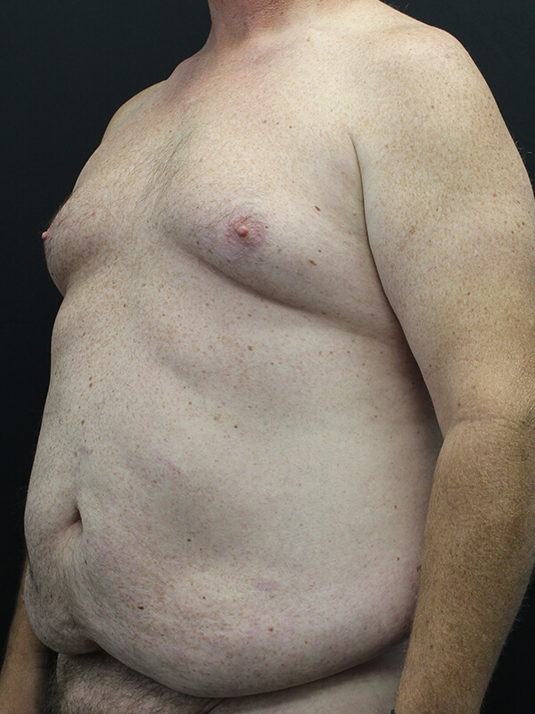 Case--6379 | Before Abdominoplasty 2