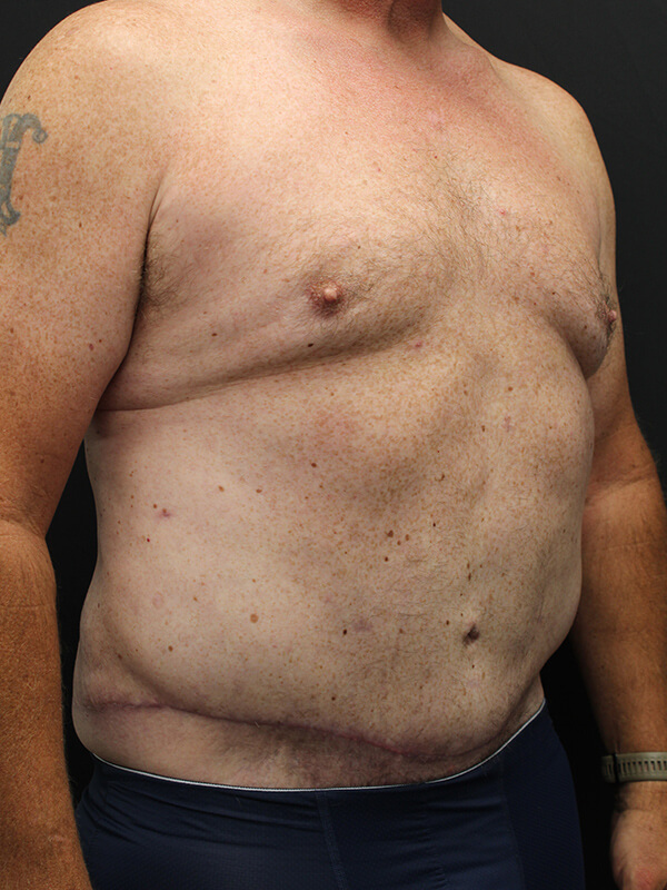 Case--6379 | After Abdominoplasty 3
