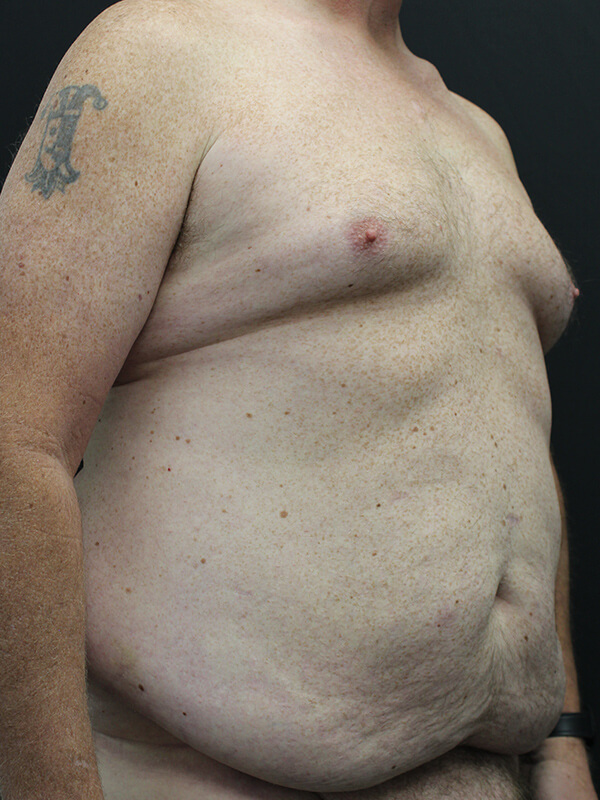 Case--6379 | Before Abdominoplasty 3