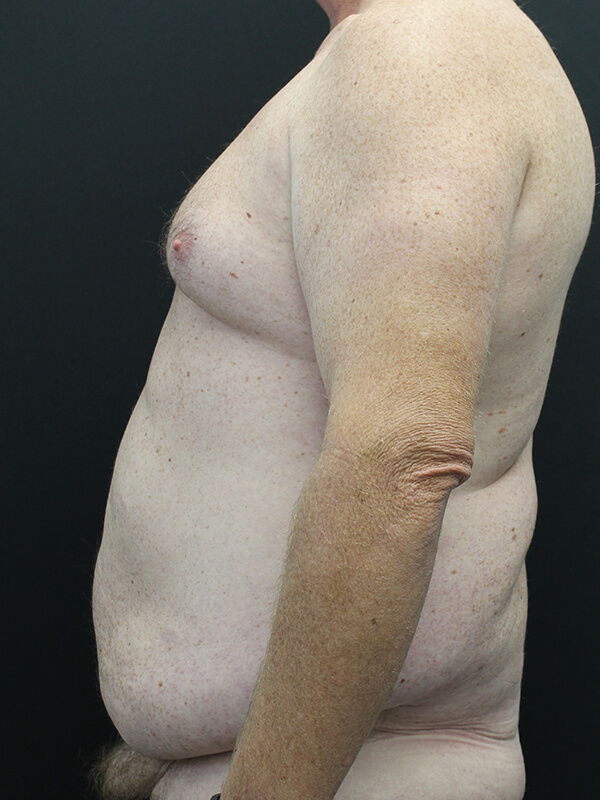 Case--6379 | Before Abdominoplasty 4
