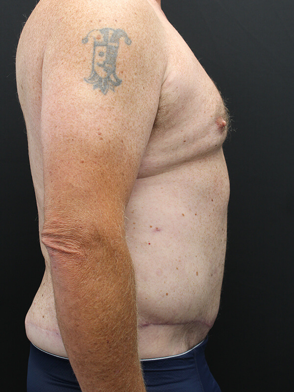 Case--6379 | After Abdominoplasty 5