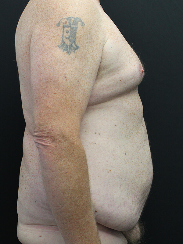 Case--6379 | Before Abdominoplasty 5