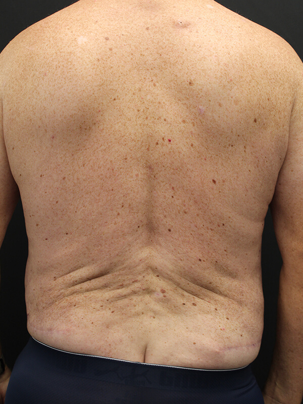 Case--6379 | After Abdominoplasty 6