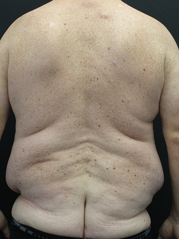 Case--6379 | Before Abdominoplasty 6