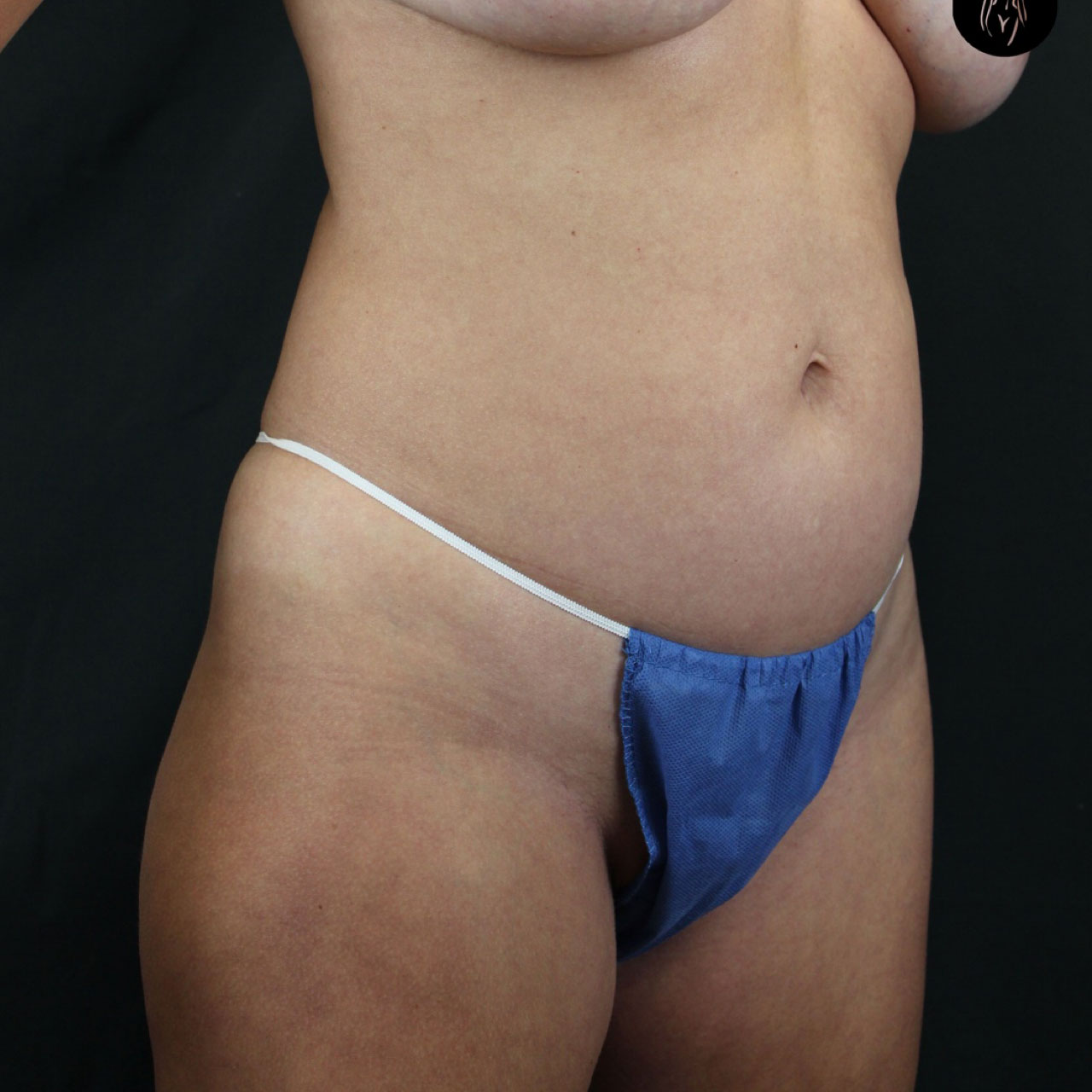 Case--2697 | Before Liposuction 2