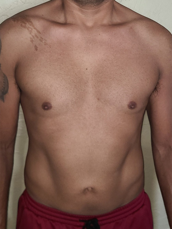 Case--1748 | After Liposuction 1