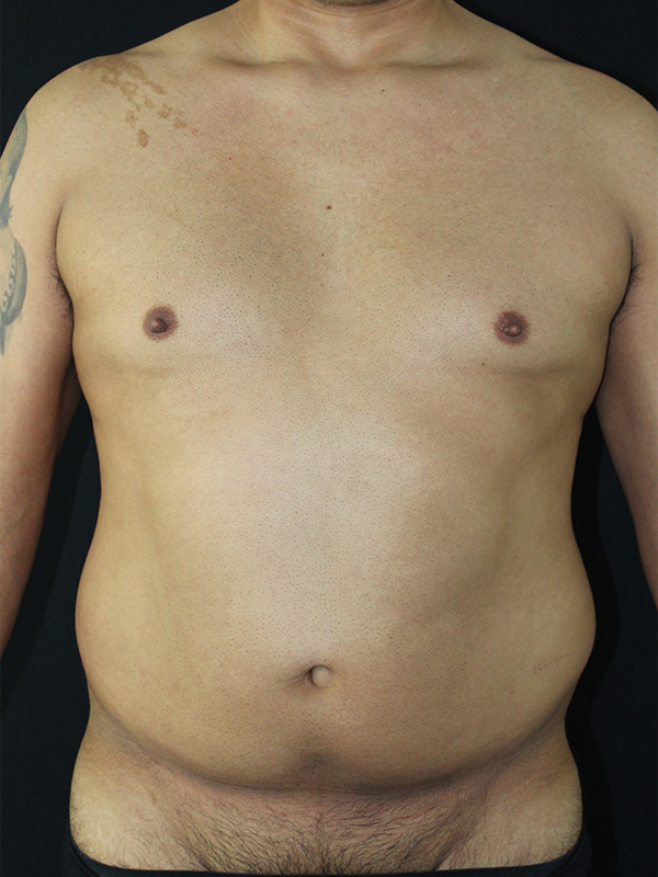 Case--1748 | Before Liposuction 1