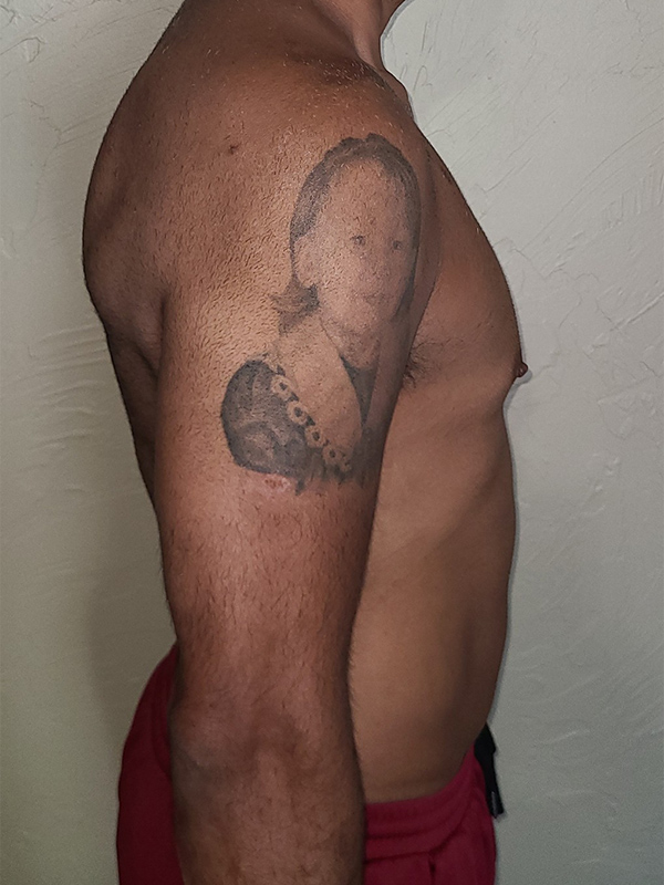 Case--1748 | After Liposuction 2