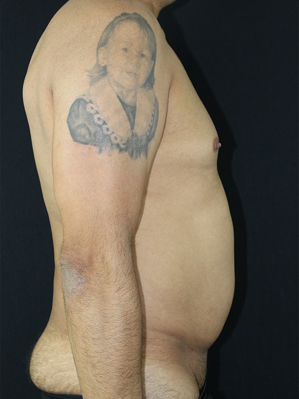 Case--1748 | Before Liposuction 2