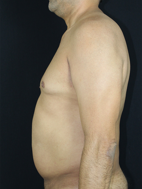 Case--1748 | Before Liposuction 3