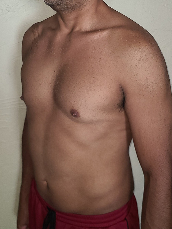 Case--1748 | After Liposuction 4