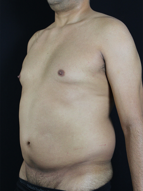 Case--1748 | Before Liposuction 4