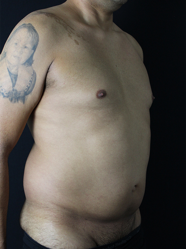 Case--1748 | Before Liposuction 5