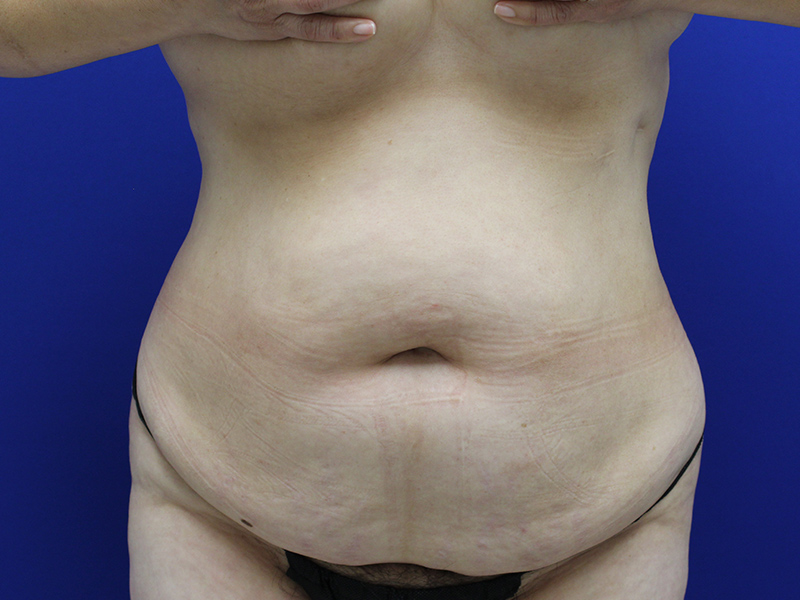 Case--7586 | Before Abdominoplasty 1