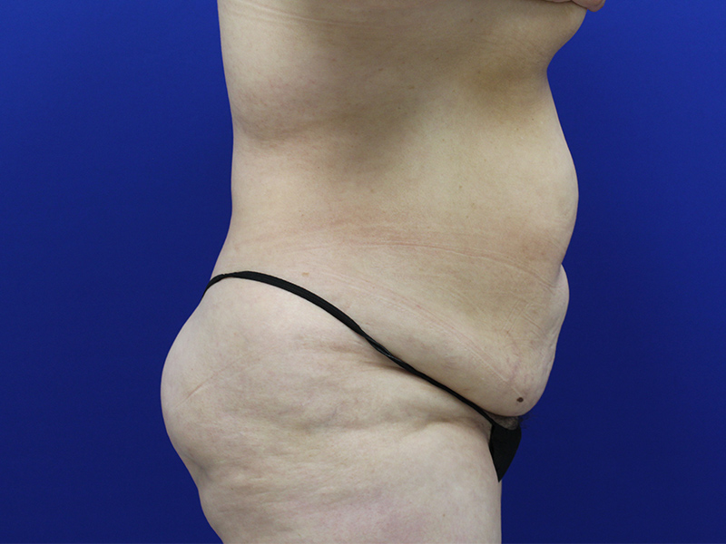 Case--7586 | Before Abdominoplasty 2