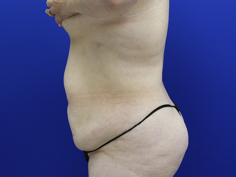 Case--7586 | Before Abdominoplasty 3