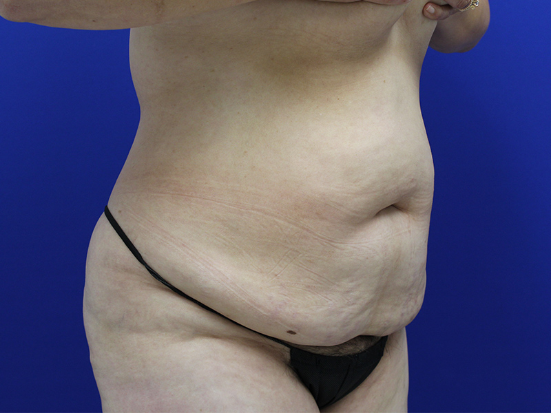 Case--7586 | Before Abdominoplasty 4
