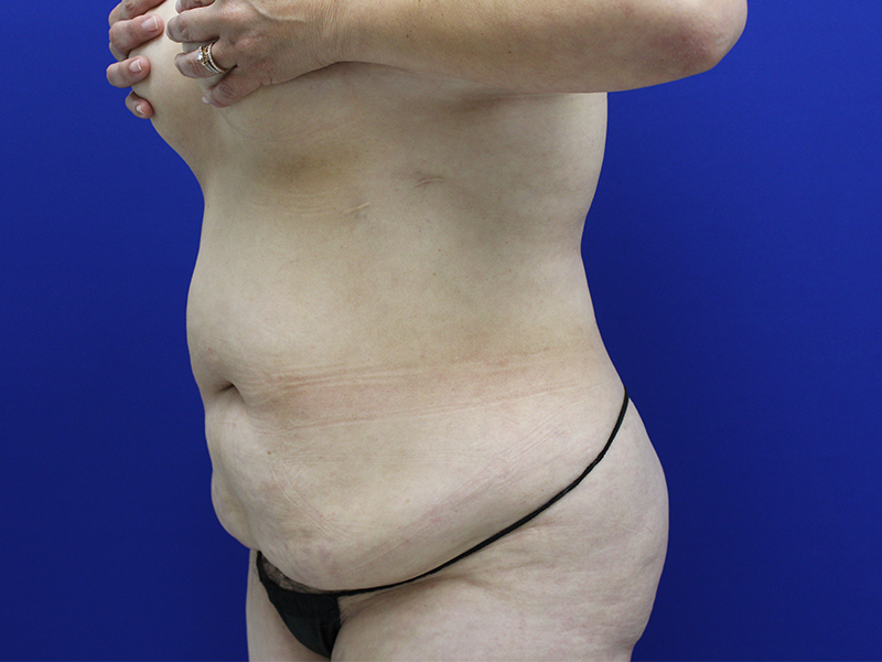Case--7586 | Before Abdominoplasty 5