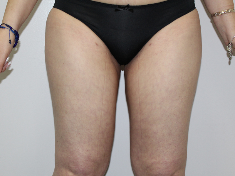 Case--2037 | Before Liposuction 1